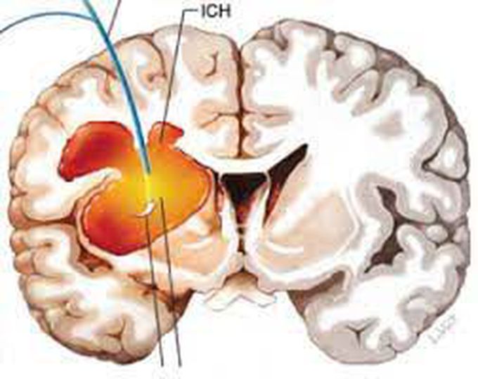 Causes of intracranial hemorrhages