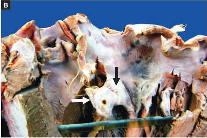 Rheumatic valvulitis