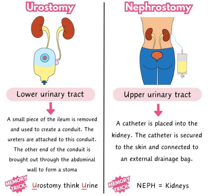 Urostomy Vs Nephrostomy