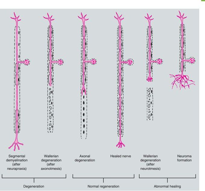 Nerve injury