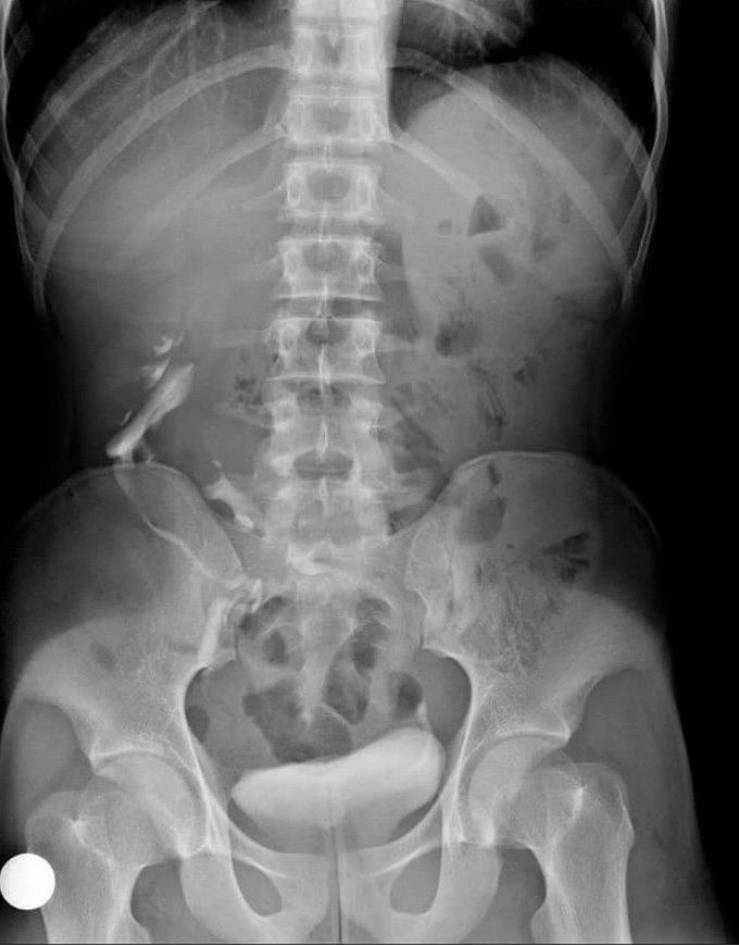 What's this intravenous urogram showing??