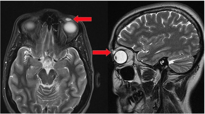 Doctors Find Lost Contact Lens In Woman's Eye Nearly 3 Decades Later
