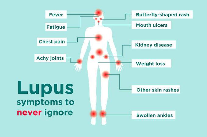 These are the symptoms of lupus like  syndrome