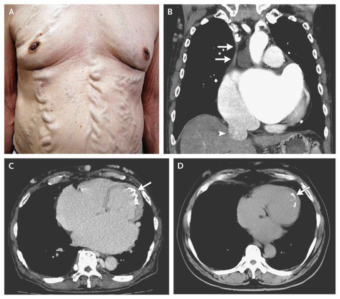 Endocardial Calcification in Behçet's Disease