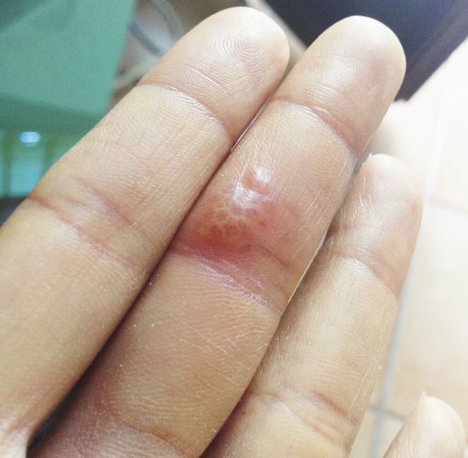 Herpetic Whitlow