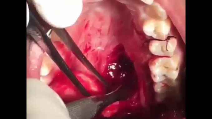 Surgical Excision of Pleomorphic Adenoma