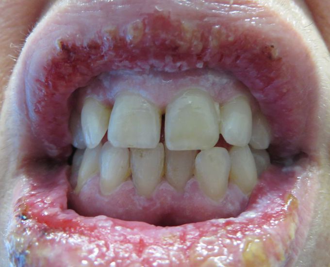 Symptoms of Pyostomatitis vegetans