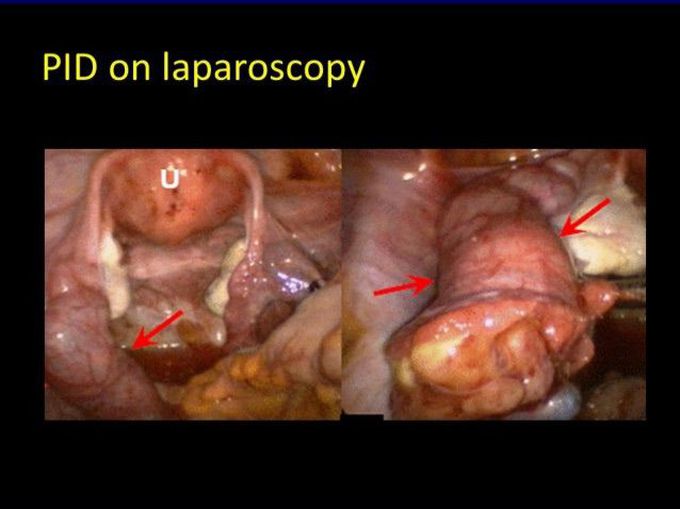 Pelvic Inflammatory Disease (PID)