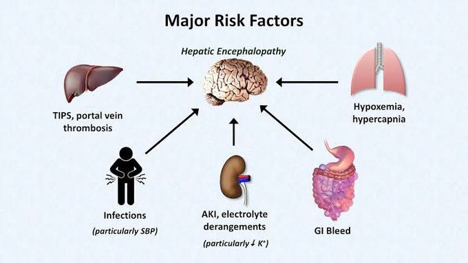 Hepatic encephalopathy