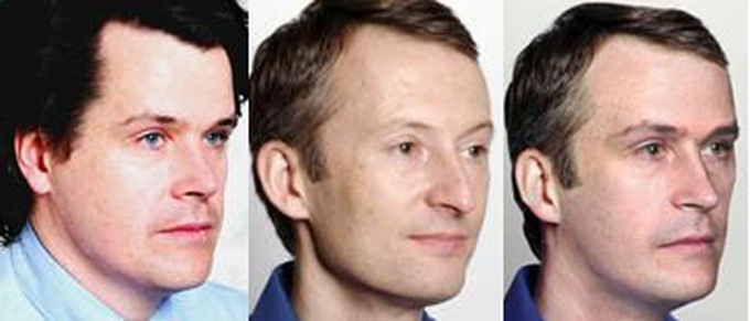 Changing identity – face transplant ethics