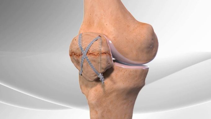 Patella Fracture Repair- Animated