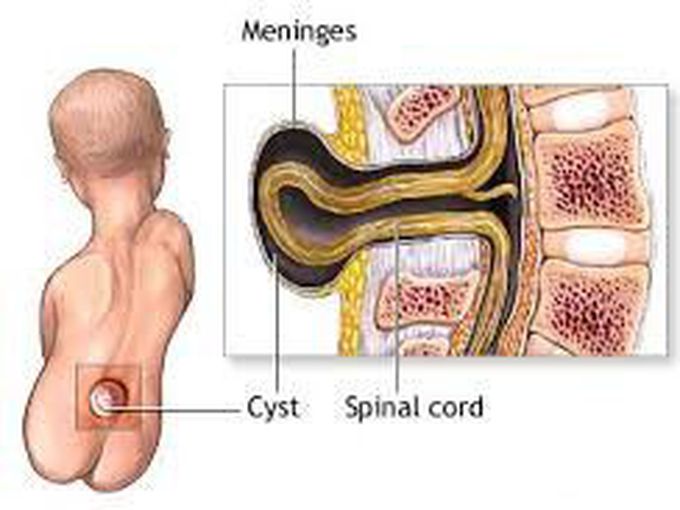 Meningocele