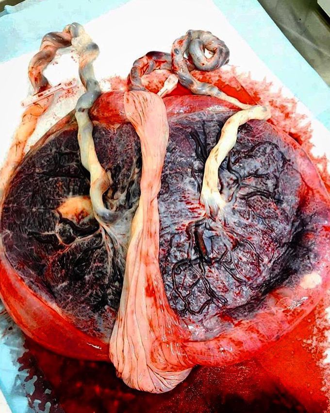 Placenta