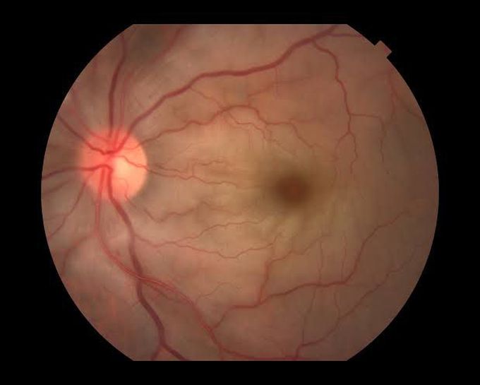 Central retinal artery occlusion