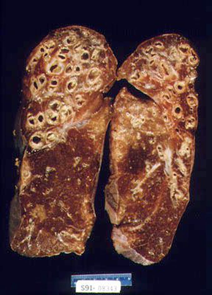 Gross Appearance of Lungs in Bronchiectasis