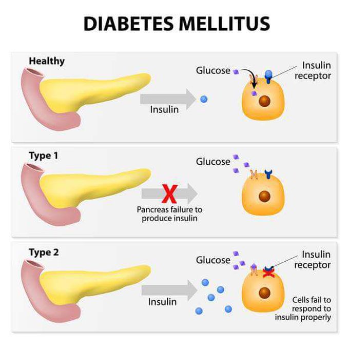 Diabetes