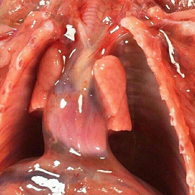 Pulmonary hypoplasia