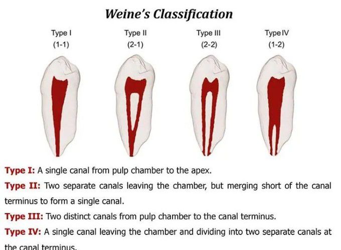 Weine's classification
