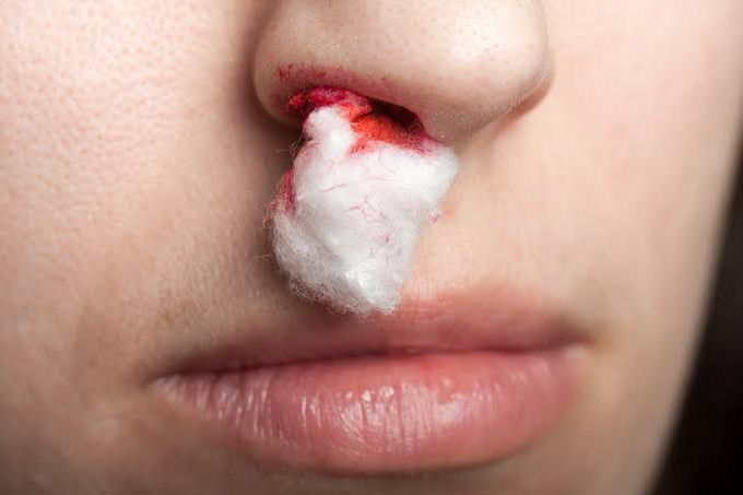 Managing the Bleeding Nose...