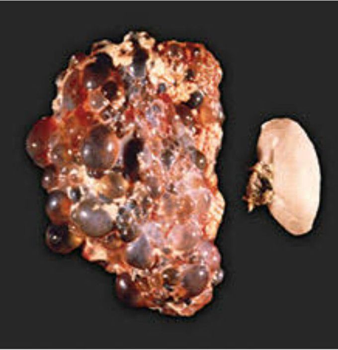 Autosomal Dominant Polycystic Kidney Disease
