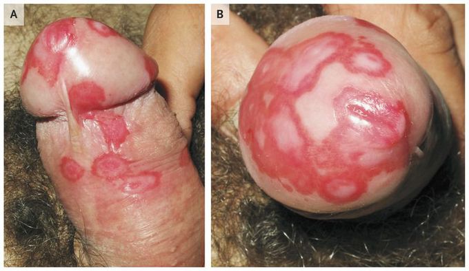 Circinate Balanitis