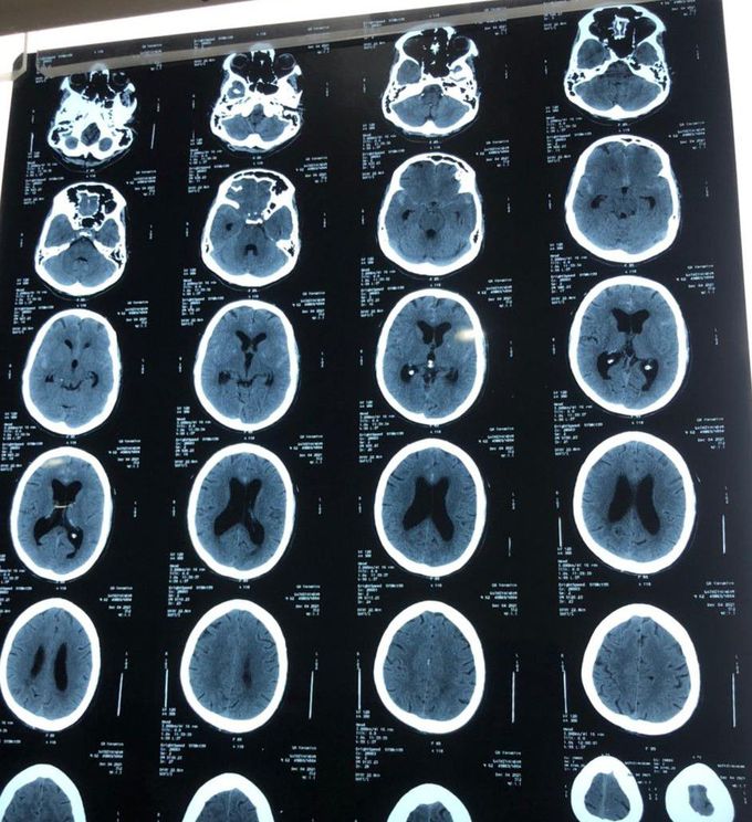 Hydrocephalus due to subarachnoid haemorrhage