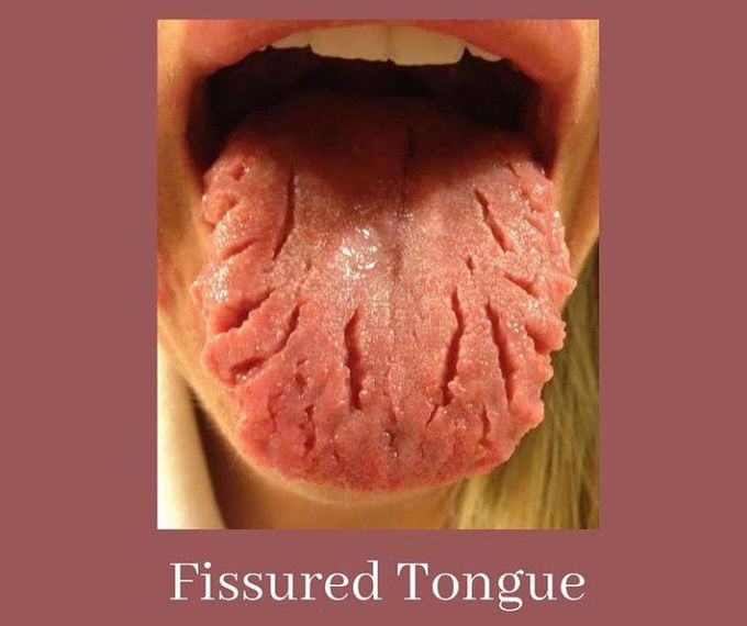 Fissured Tongue