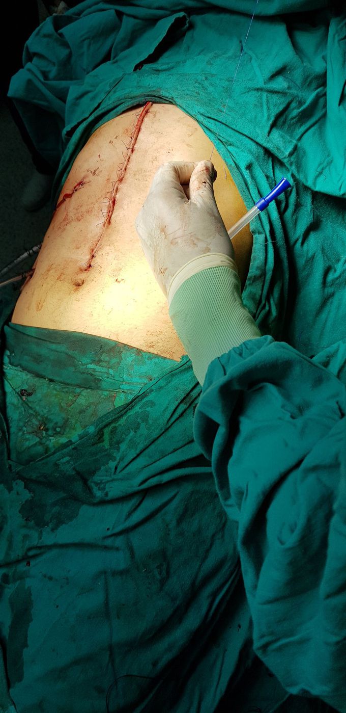 After removed liver cyst above  portahepatis