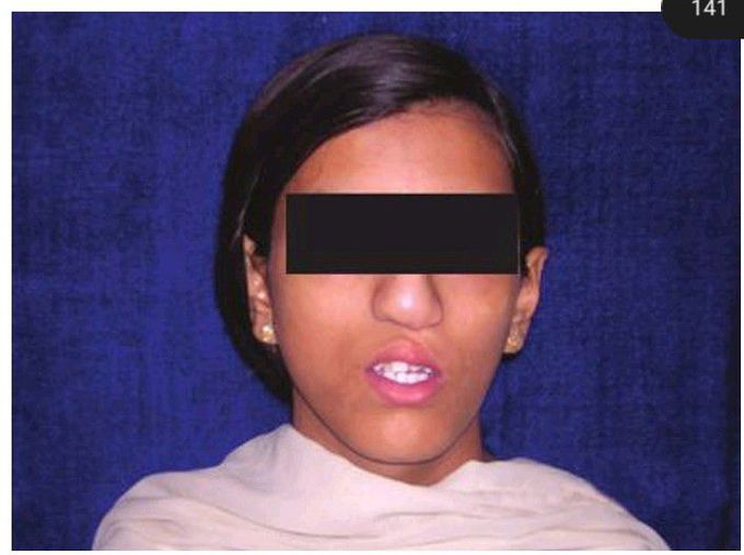 Crouzon's syndrome