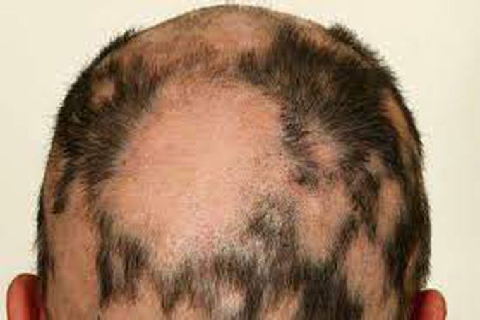 What are the symptoms of alopecia areata?