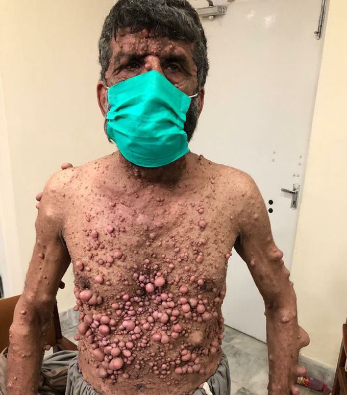 Neurofibromatosis