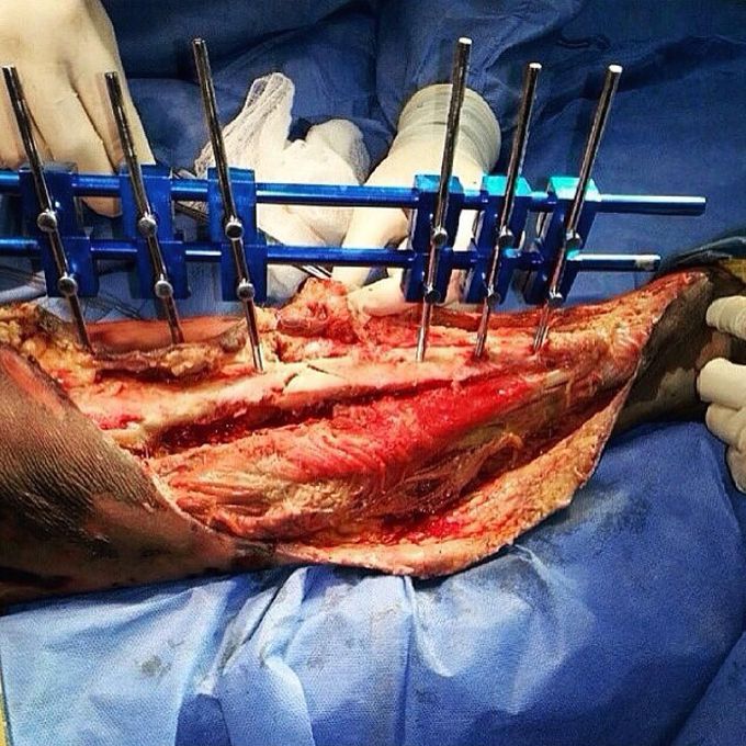 Open Reduction and External Fixation (OREF) of an open tibial shaft fracture!