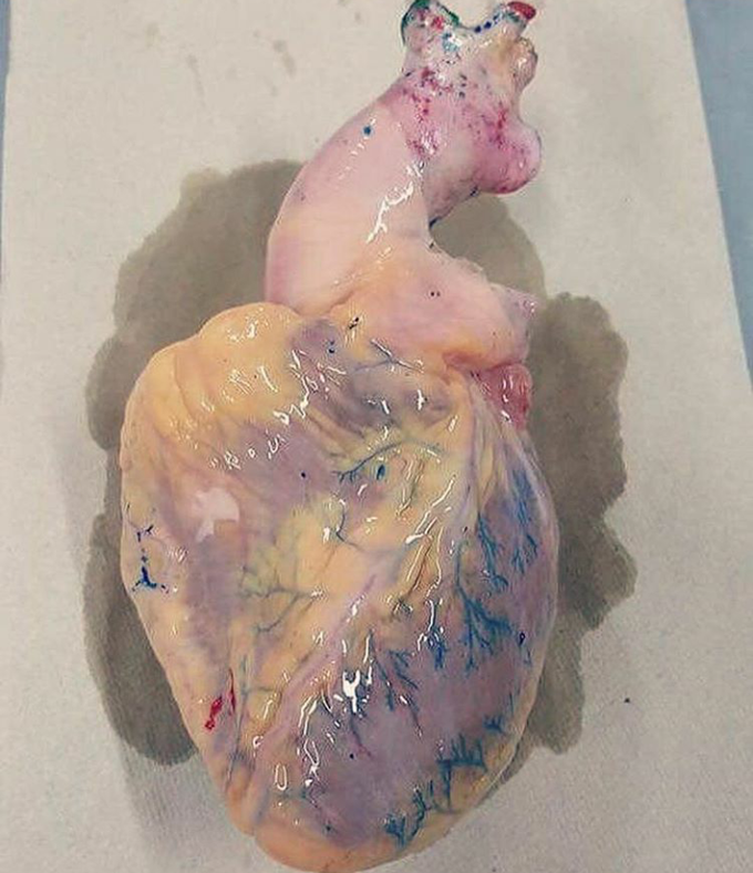Heart of a patient suffered from an Infraction