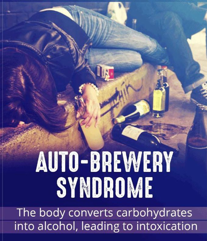 Auto-Brewery Syndrome