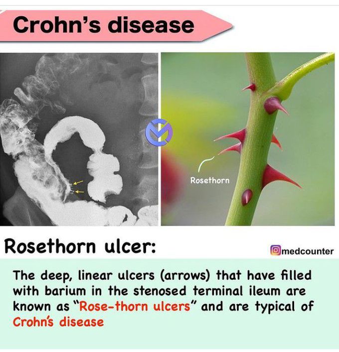 Rosethorn ulcer of crohn's disease