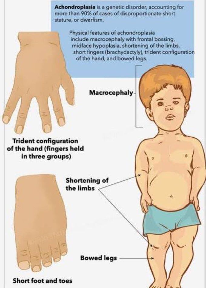 Achondroplasia