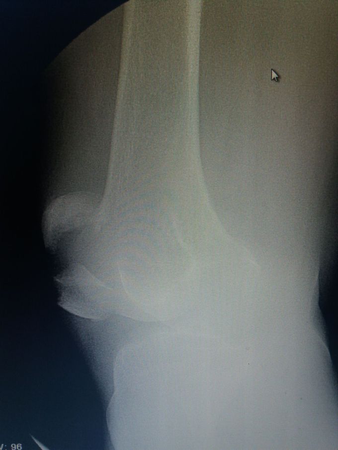 Fracture of patella