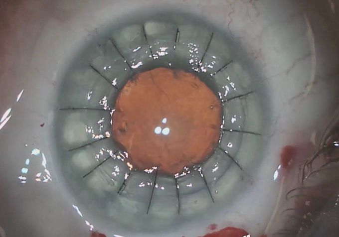 Cornea transplant on an eye with prior RK surgery in 3 minutes