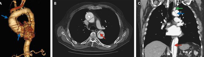Aortic Dissection