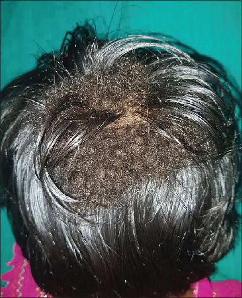 What is Wooly Hair Nevus Syndrome? - MEDizzy