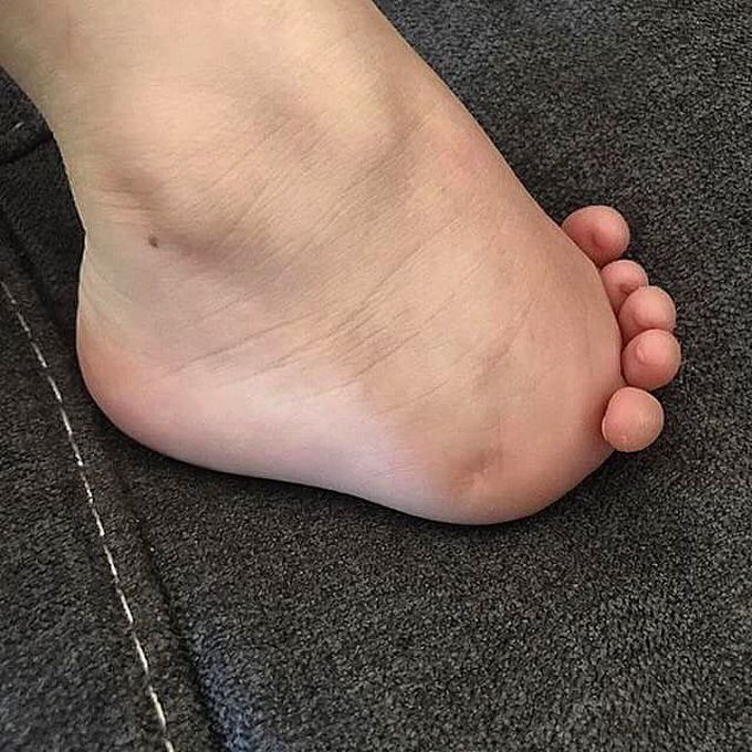 amniotic band syndrome toes