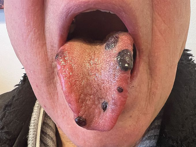 Spontaneous Oral Purpura in Immune Thrombocytopenia