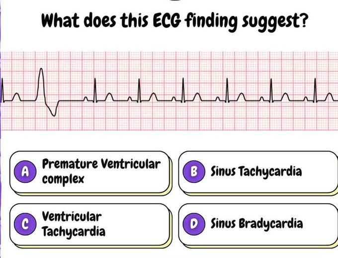 Identify the ECG Finding