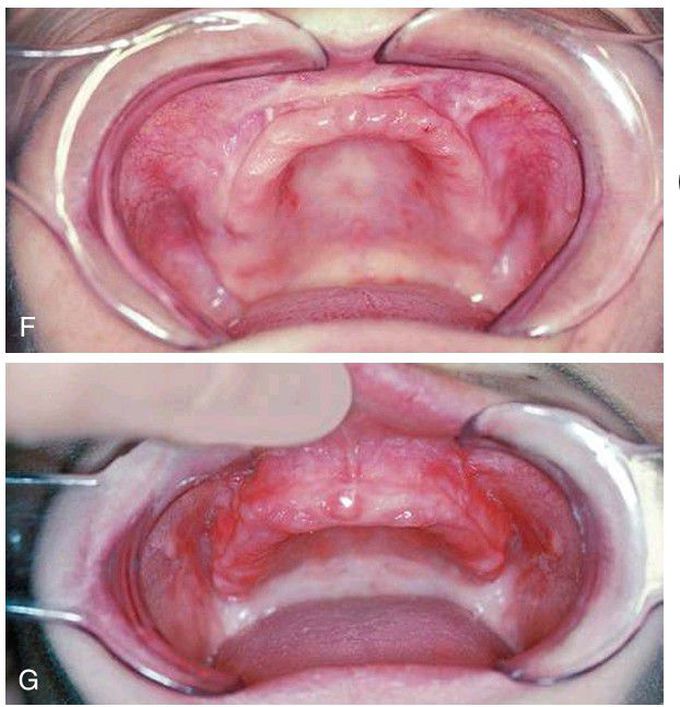 Vestibuloplasty case study