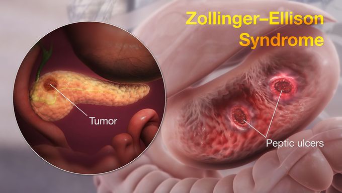 Zollinger-Ellison syndrome