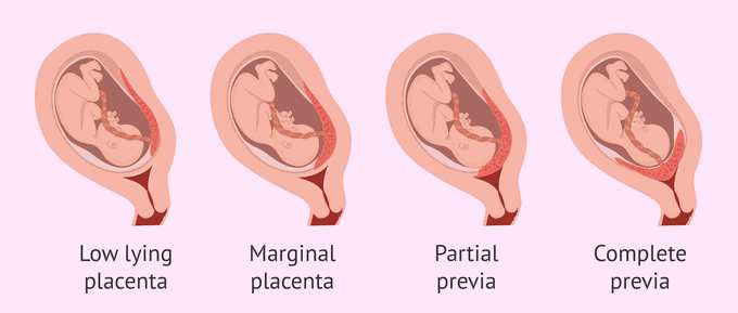 Types of Placenta Previa
