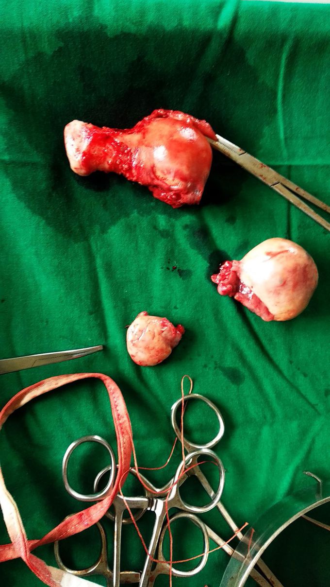 hysterectomy surgery