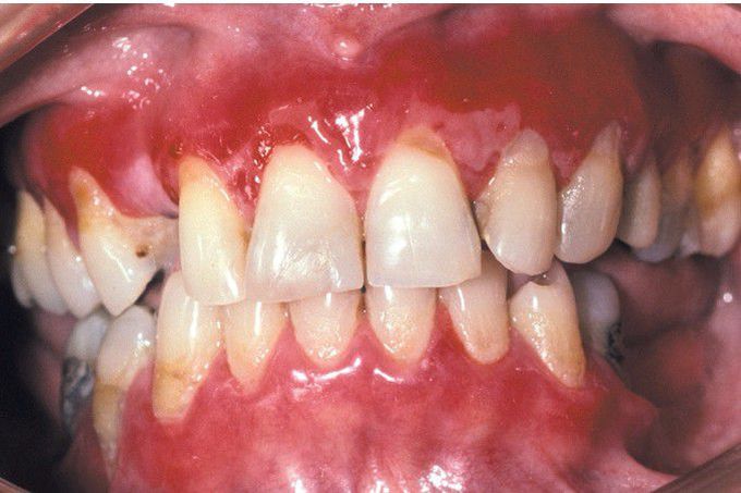 Mucous Membrane Pemphigoid