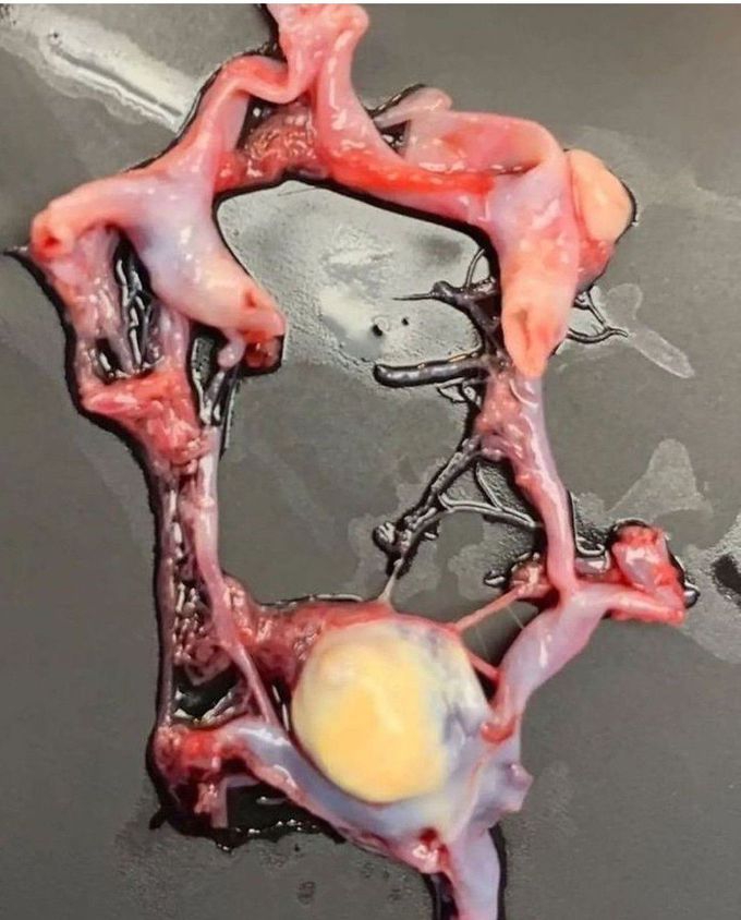 Aneurysm In The Circle Of Willis