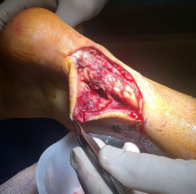 Ruptured Achilles' tendon surgery
